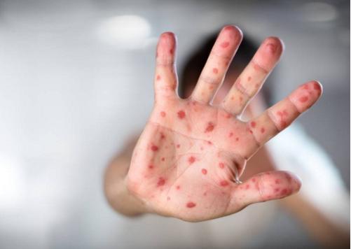 Gripe mata 4 em Sorocaba; Dengue contamina quase mil e sarampo chegou